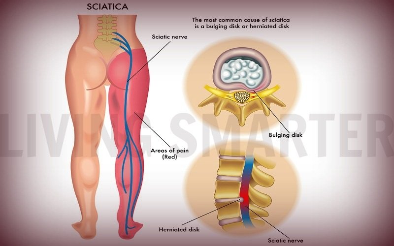 xsciatica1.jpg.pagespeed.ic.qwatPhRr43